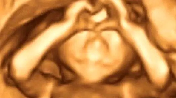 ژست عجیب جنین درون شکم مادرش +عکس