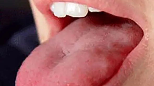 نشانه های سرطان زبان چیست؟