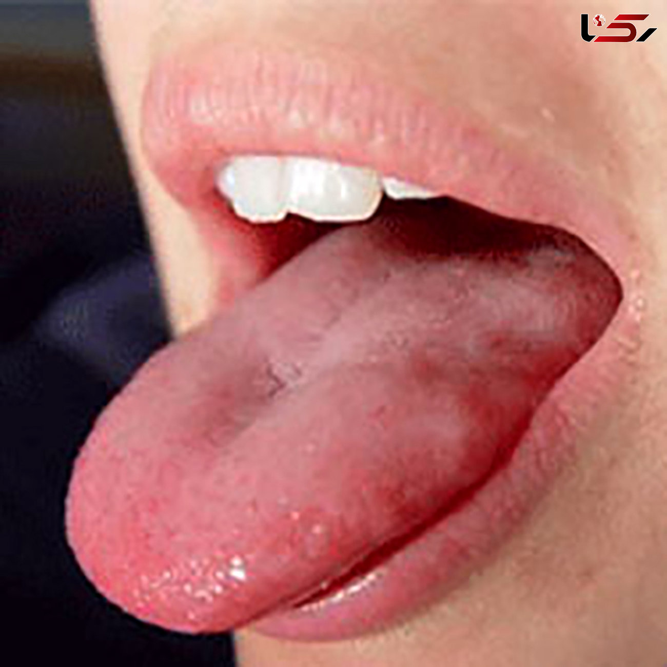 نشانه های سرطان زبان چیست؟