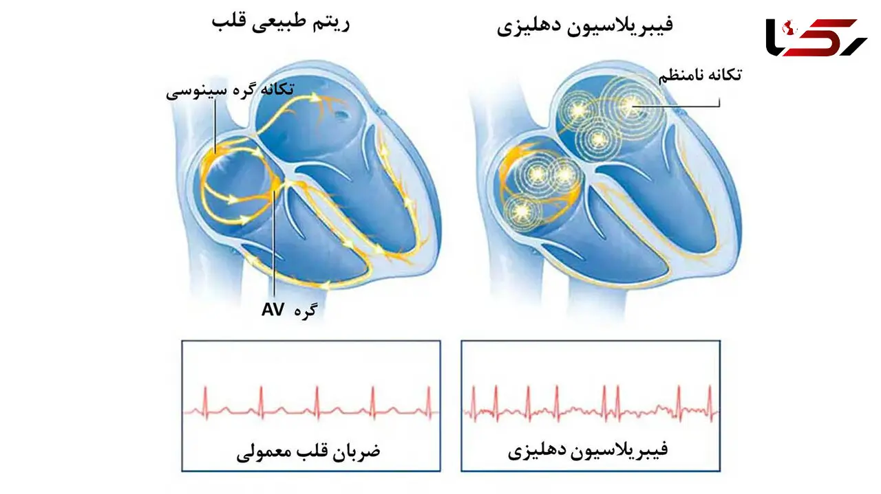 علائم هشدار دهنده برای ضربان قلب غیرعادی چیست؟