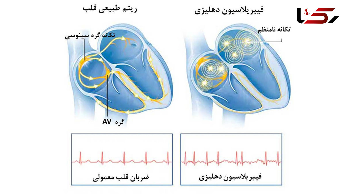  علائم هشدار دهنده برای ضربان قلب غیرعادی چیست؟ 