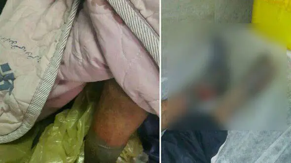 دستور وحشتناک دکتر به قطع پاهای یخ زده مرد کارتن خواب+عکس