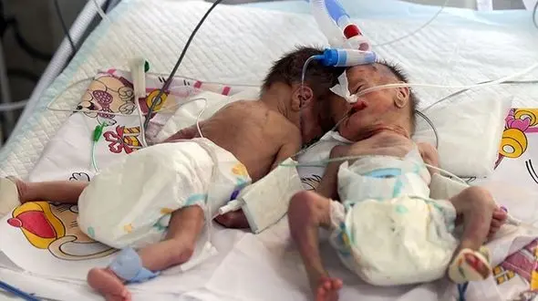  دوقلو‌های نیکشهری چرا جان باختند؟!+عکس