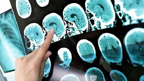 درمان بیماری ام اس محقق شد