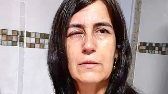 مردی چسب قطره ای را به جای قطره چشم به چشمان زنش ریخت !+ عکس