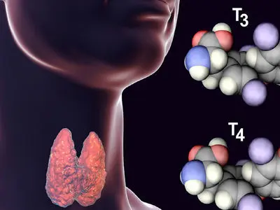 چه چیزی باعث تیروئید می شود؟ بررسی عوامل مهم