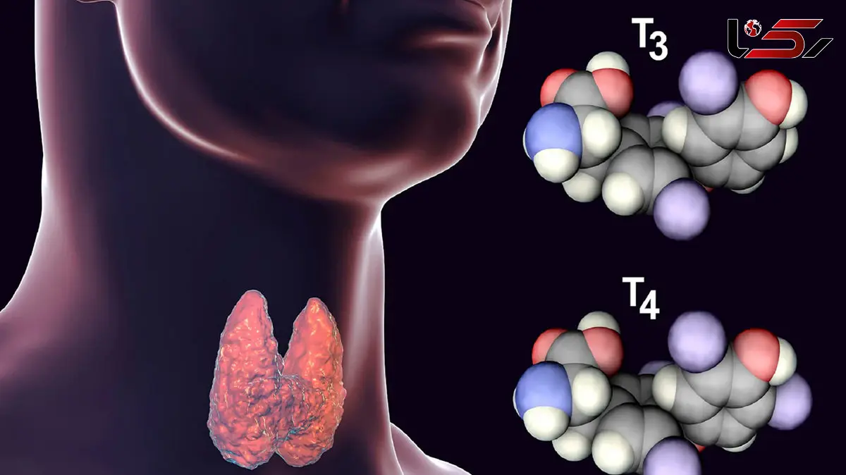 چه چیزی باعث تیروئید می شود؟ بررسی عوامل مهم
