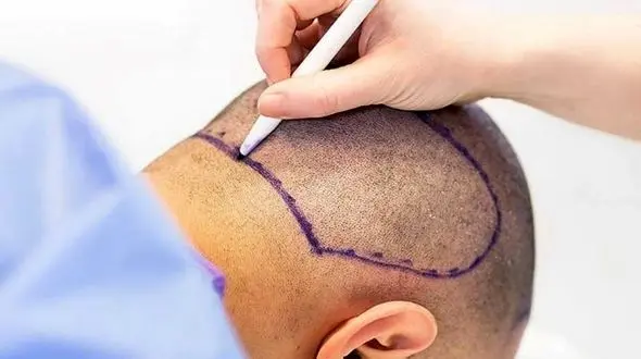 هزینه کاشت مو براساس چه عواملی محاسبه می شود؟