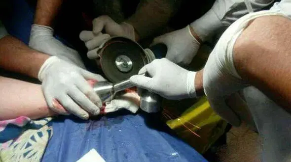 دست کودک ۱۸ ماهه قزوینی از چرخ گوشت رهاسازی شد