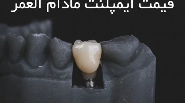 قیمت ایمپلنت مادام العمر چقدر است ؟