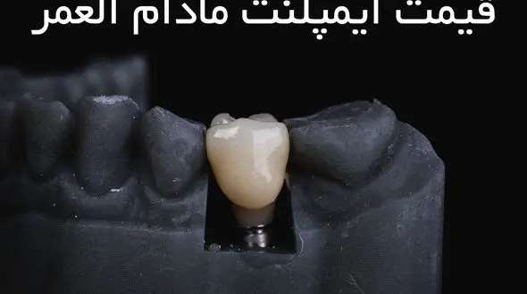 قیمت ایمپلنت مادام العمر چقدر است ؟