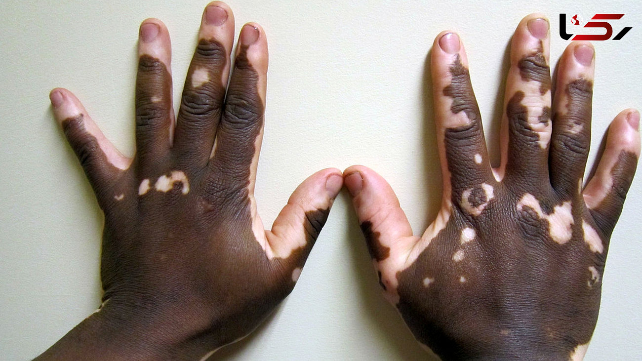 علل بروز اختلال در تولید رنگدانه پوست و بروز بیماری لک و پیس