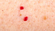 انواع لکه‌های قرمز روی پوست + درمان 