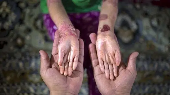 بیماری پروانه‌ای؛ ناهنجاری حاصل از ازدواج‌های فامیلی