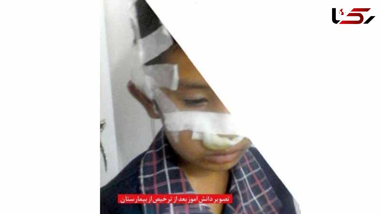 عکس تلخ تنبیه دانش آموز مشهدی / صورتش لت و پار شد! + عکس