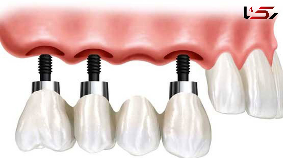 بریج بهتر است یا ایمپلنت؟ / چند و چون کاشت دندان