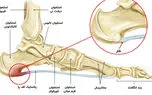 علت درد پاشنه پا چیست؟ / رایج ترین علل، انواع و بهترین روش درمان
