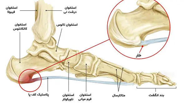 علت درد پاشنه پا چیست؟ / رایج ترین علل، انواع و بهترین روش درمان