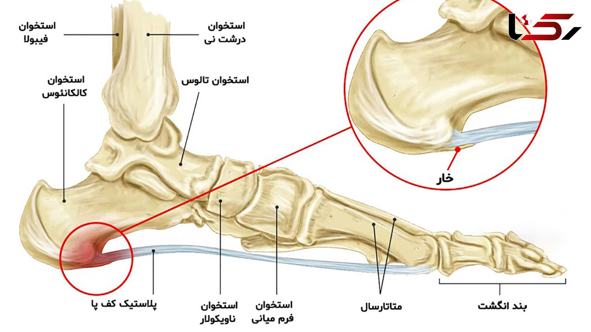 علت درد پاشنه پا چیست؟ / رایج ترین علل، انواع و بهترین روش درمان