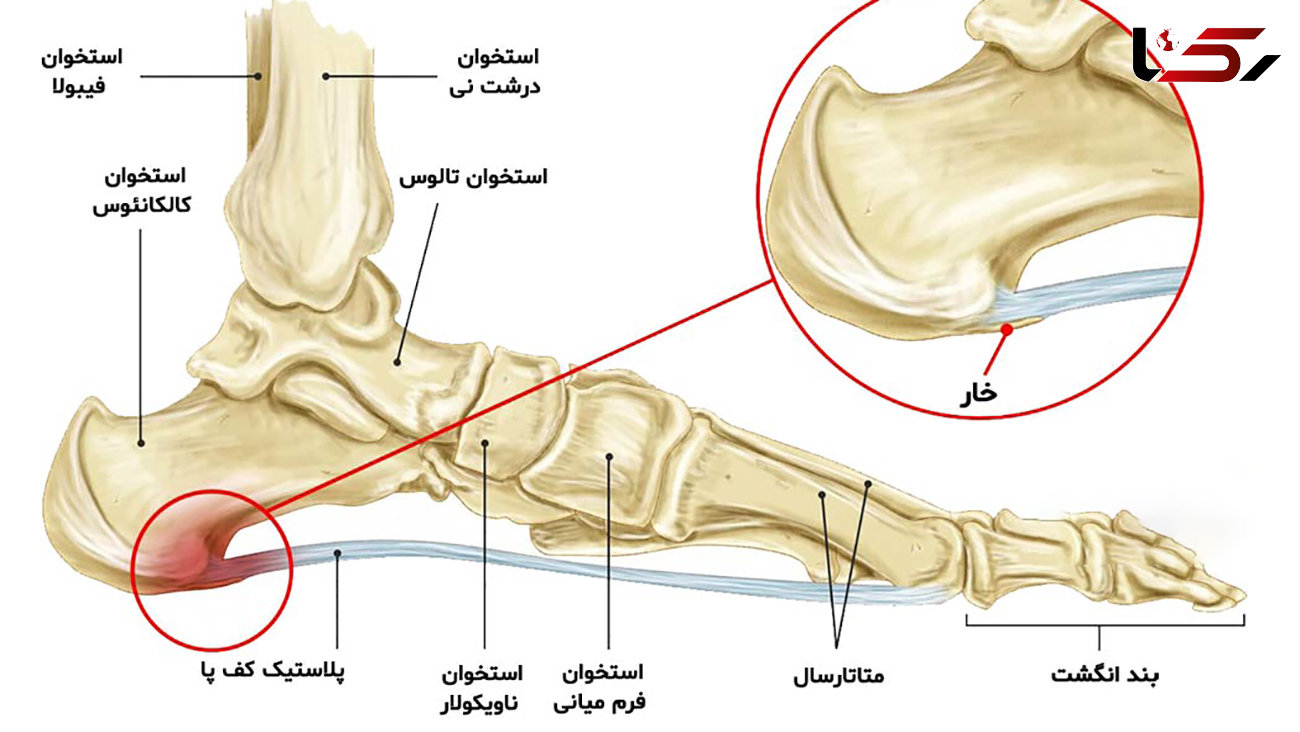 علت درد پاشنه پا چیست؟ / رایج ترین علل، انواع و بهترین روش درمان
