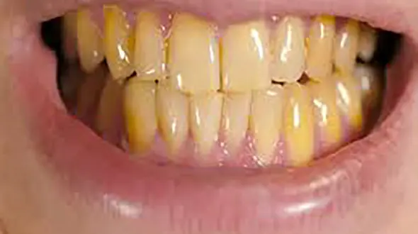 ۵ اشتباهی که باعث زردی دندان ها می شود