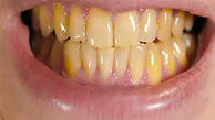 ۵ اشتباهی که باعث زردی دندان ها می شود