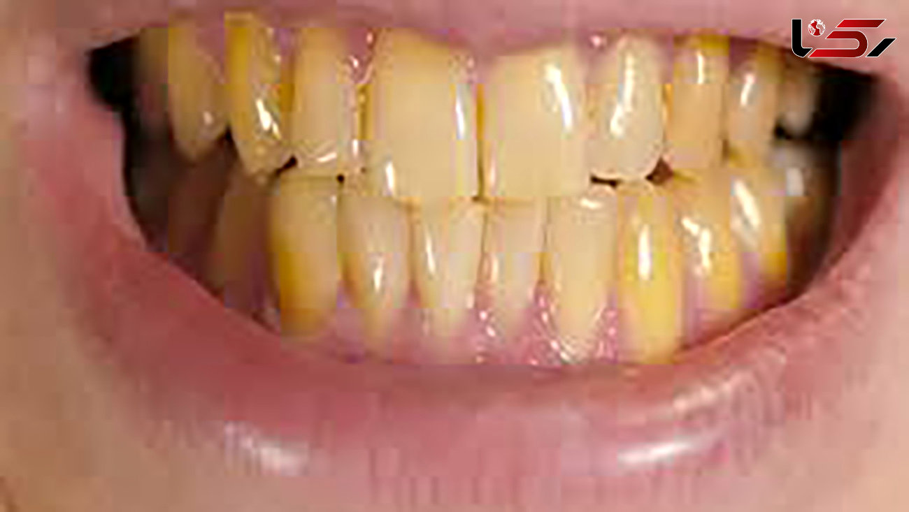 این کارها دندان هایتان را زرد می کند!