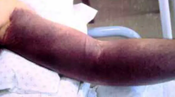 تب کشنده کریمه کنگو چیست؟  + عکس 