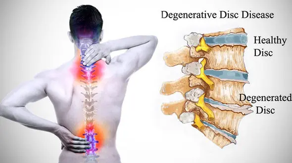 دیسک کمر چیست؟ + درمان‌ های غیر جراحی