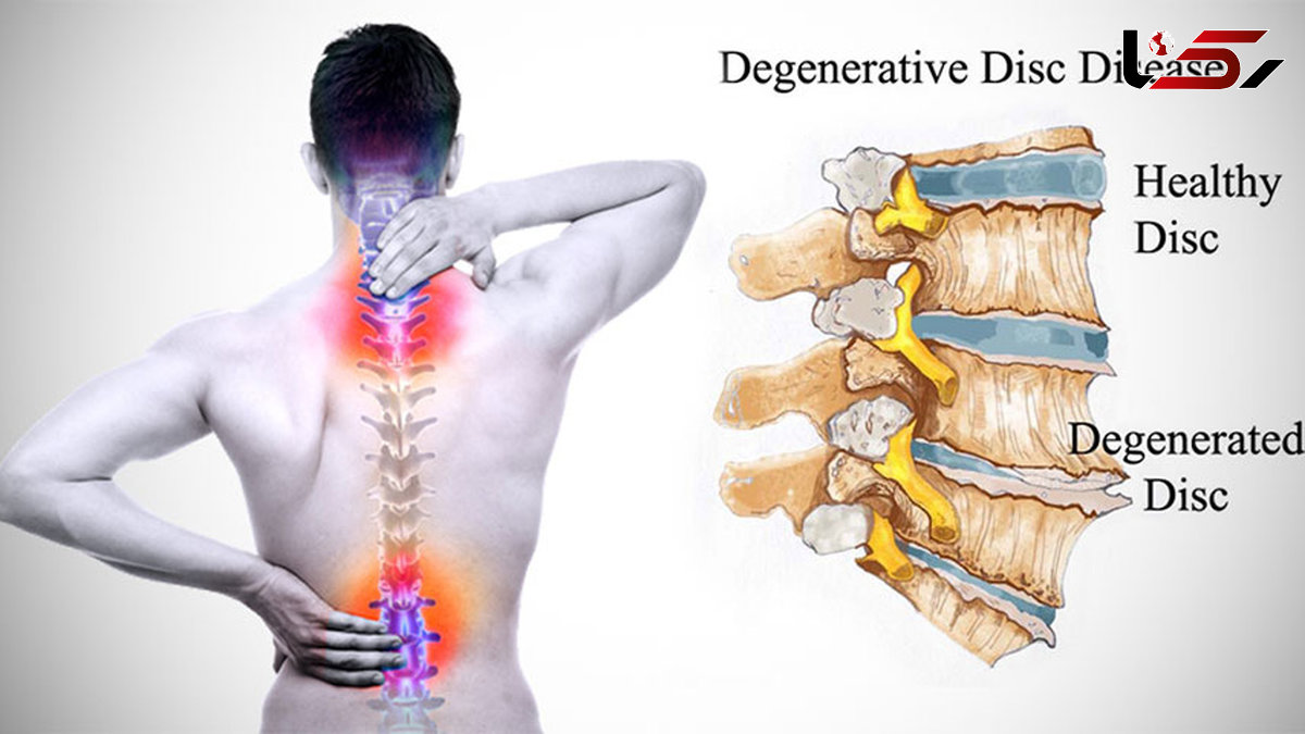 دیسک کمر چیست؟ + درمان‌ های غیر جراحی