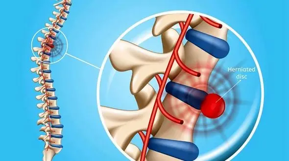 اگر دیسک کمر داری از این ترکیب خانگی استفاده کن