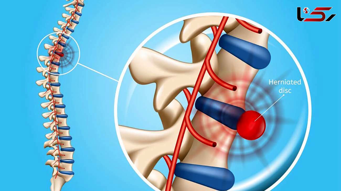 اگر دیسک کمر داری از این ترکیب خانگی استفاده کن