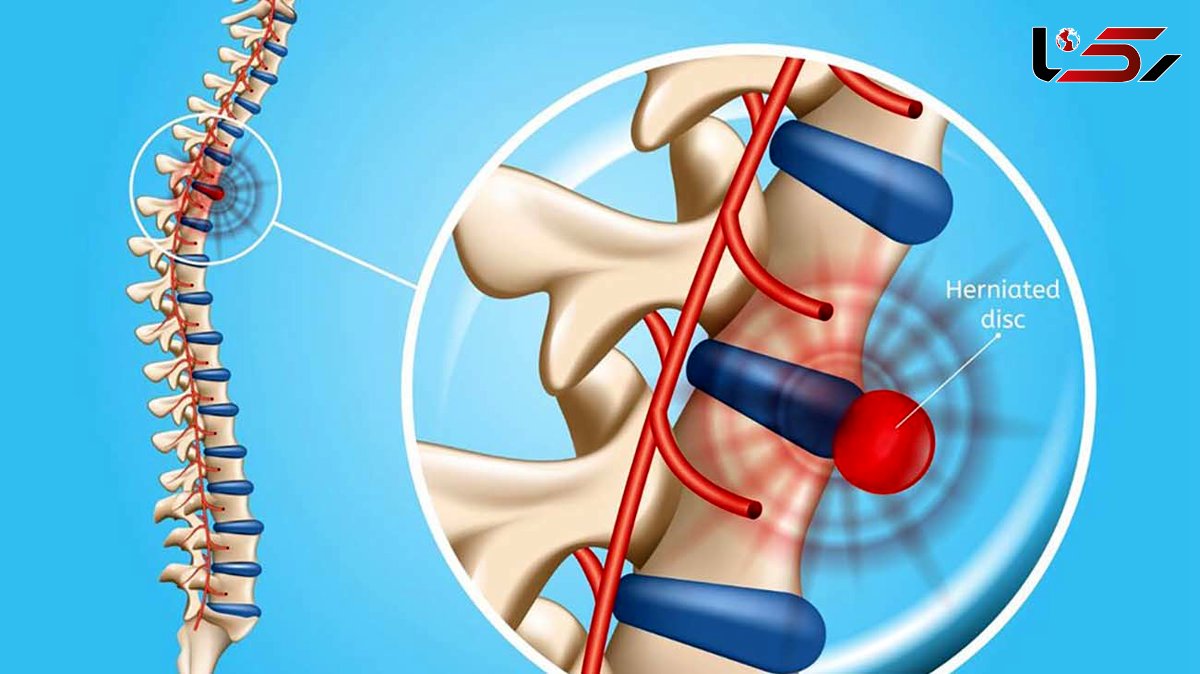 اگر دیسک کمر داری از این ترکیب خانگی استفاده کن