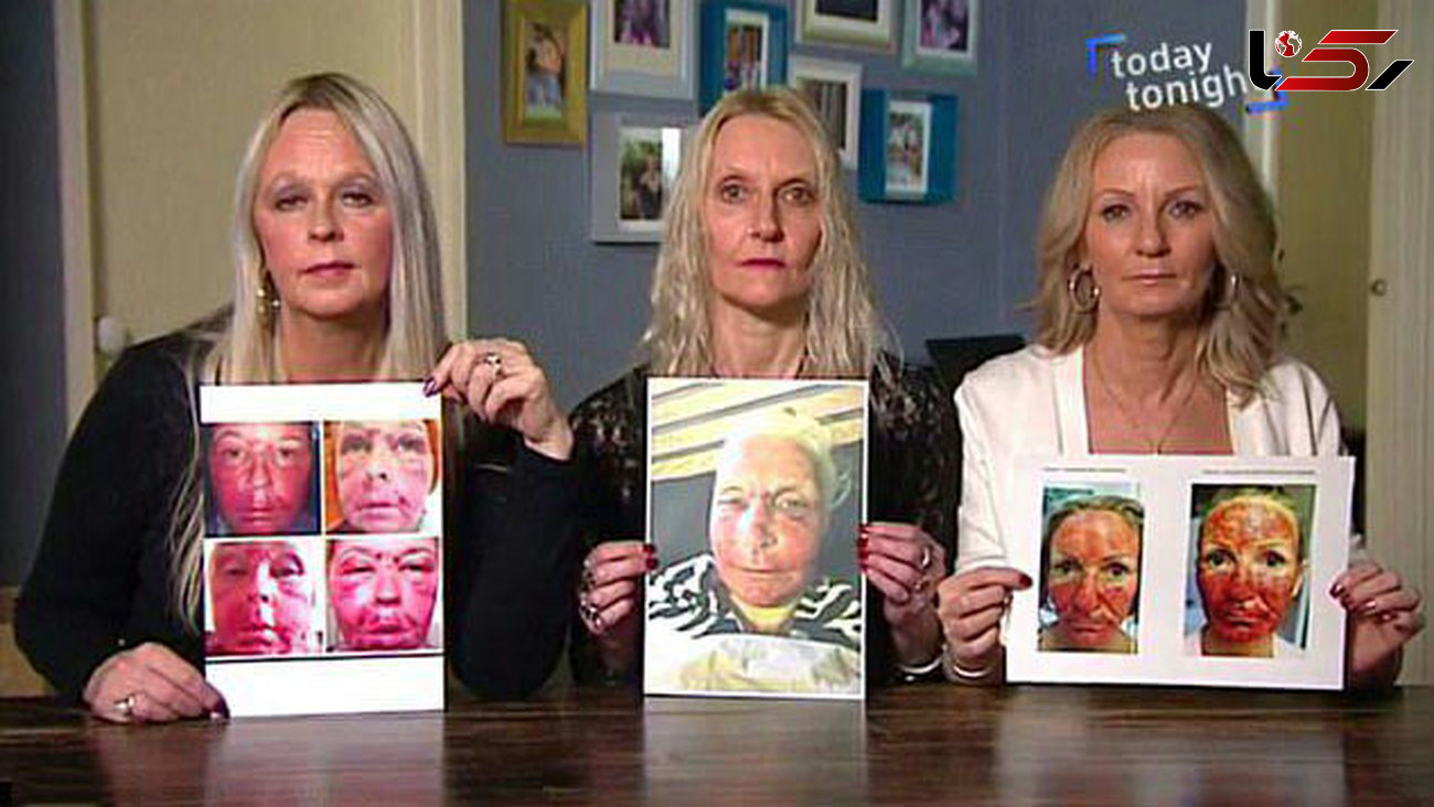 آسیب های پنهان لیزر زیبایی بر چهره زنان