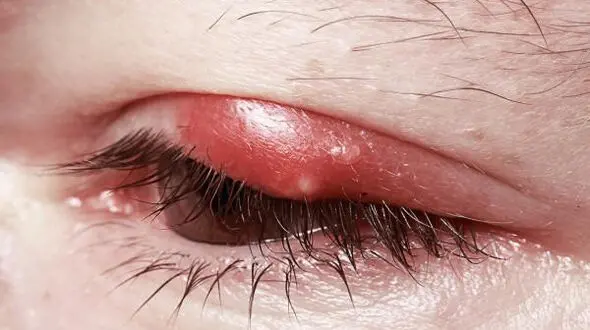  علت زدن گل مژه و درمان آن 