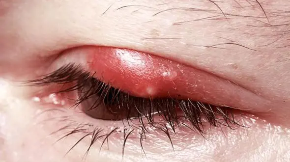  علت زدن گل مژه و درمان آن 