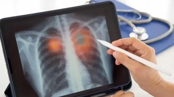 خطر نزدیک است! آیا سرفه شما نشانه برونشیت است یا ذات‌ الریه؟