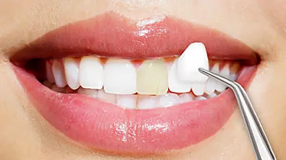 تب داغ لمینیت دندان / آیا لمینیت باعث آسیب زدن به دندان می شود؟