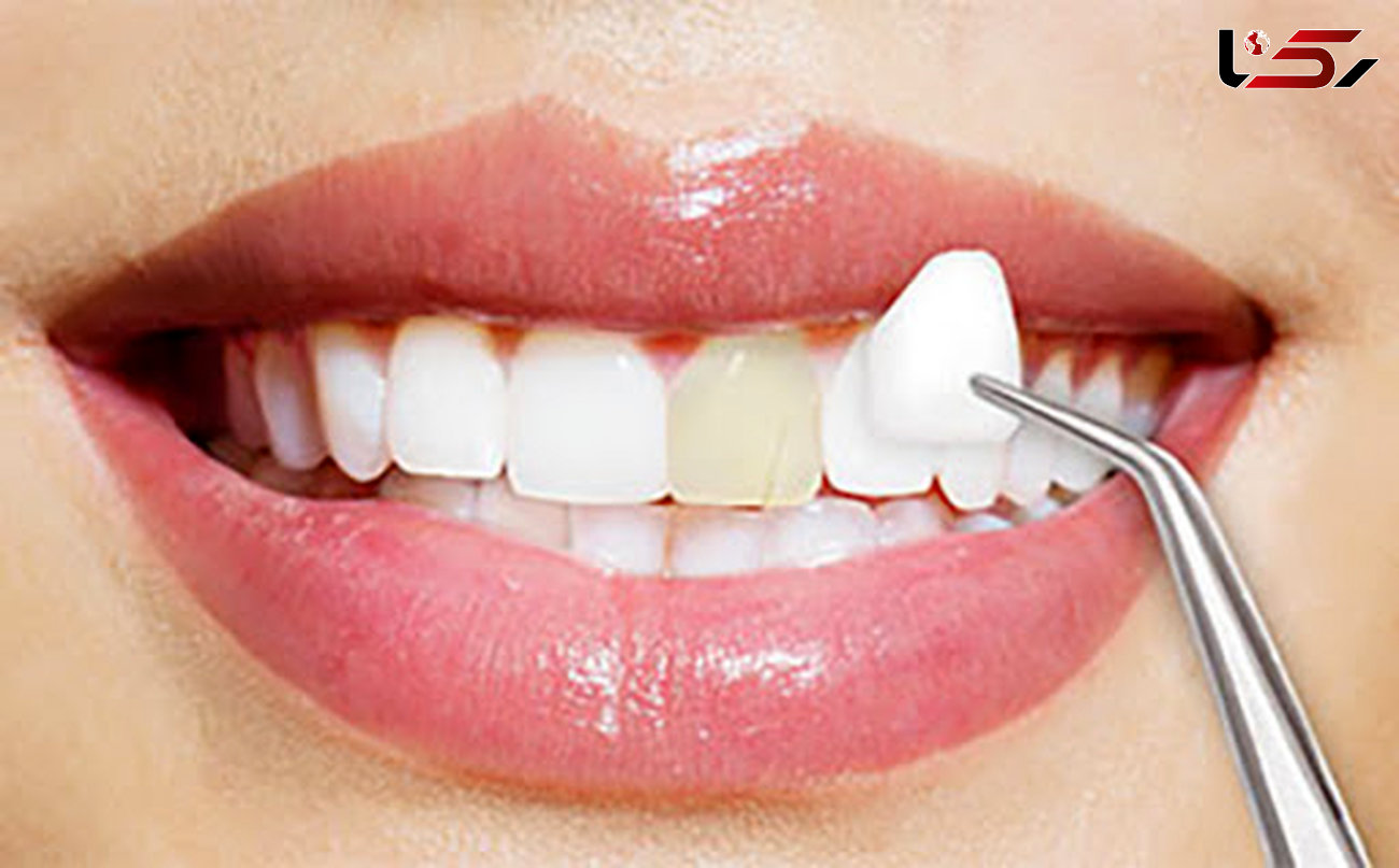 تب داغ لمینیت دندان / آیا لمینیت باعث آسیب زدن به دندان می شود؟