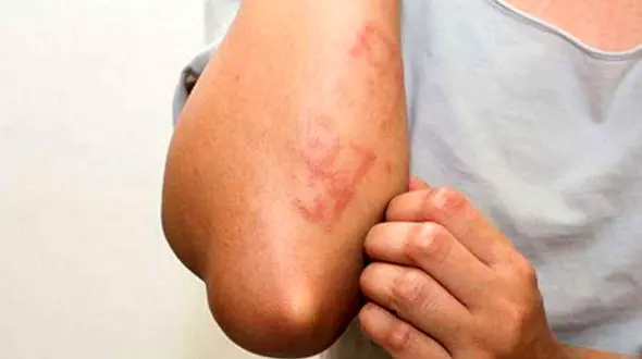 علائم یک بیماری پوستی که در استان های شمالی کشور شایع تر است/ سارکوئیدوز  را بیشتر بشناسید