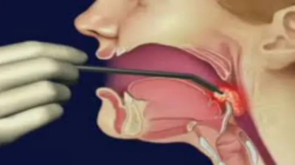 سرطان حنجره و سر با مصرف دخانیات 