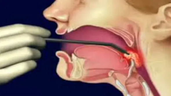 سرطان حنجره و سر با مصرف دخانیات 