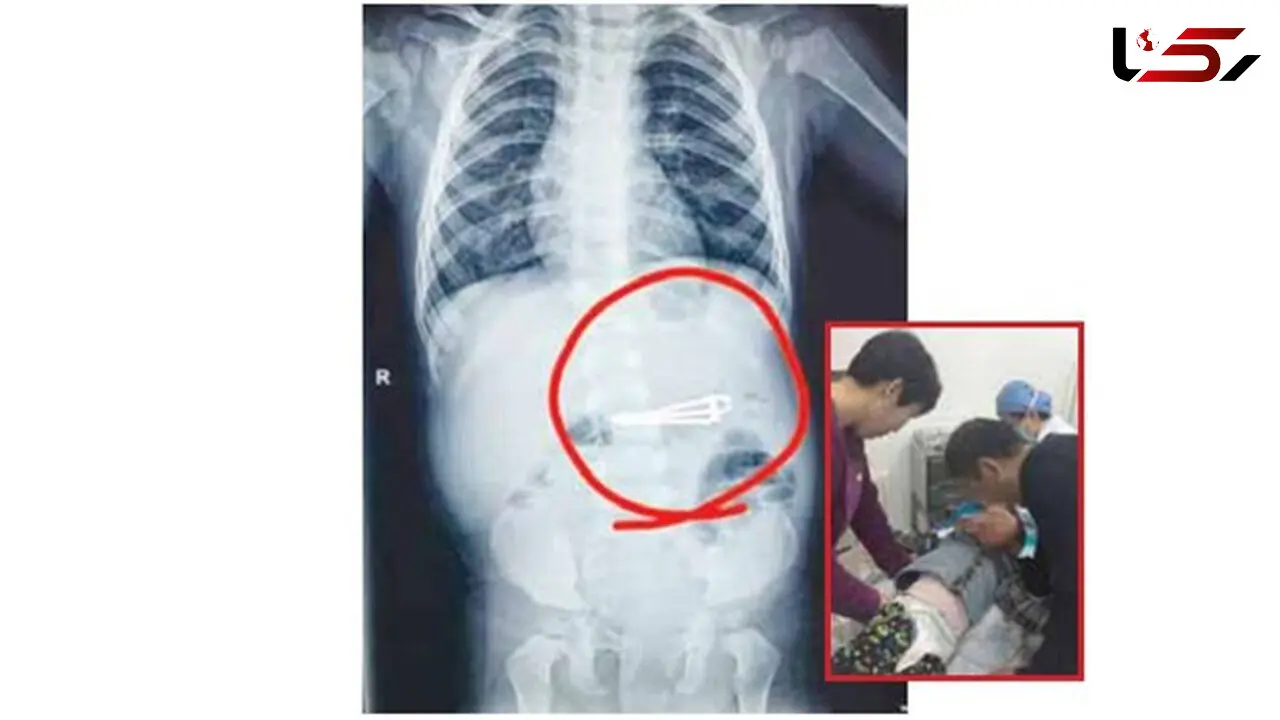 ناخن گیر در شکم کودک 16 ماهه+ عکس