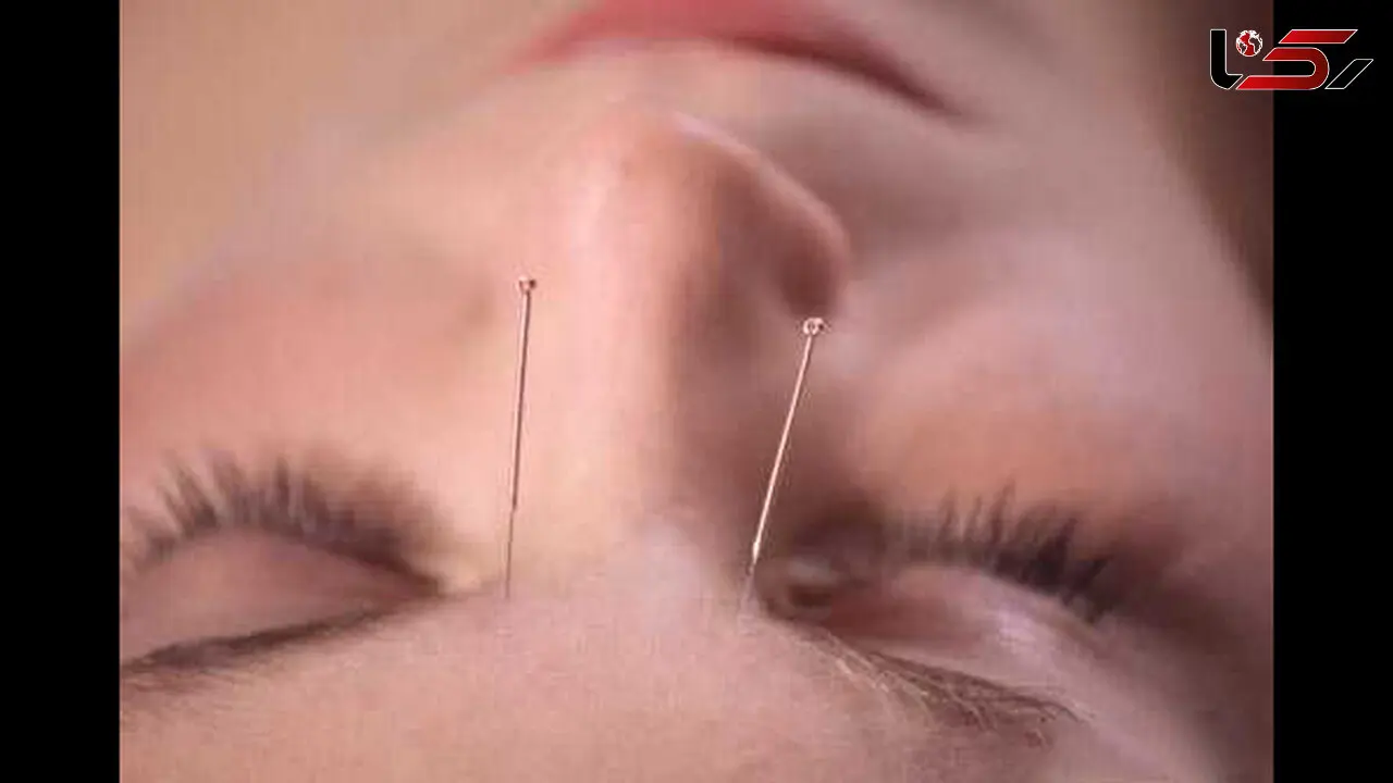 طب سوزنی لیفتینگ صورت جایگزین روشهای جراحی 