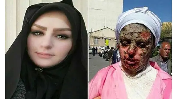 جزئیات مرگ عامل اسیدپاشی به دختر تبریزی در زندان + عکس چهره معصومه قبل و بعد از اسیدپاشی 