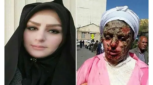 جزئیات مرگ عامل اسیدپاشی به دختر تبریزی در زندان + عکس چهره معصومه قبل و بعد از اسیدپاشی 