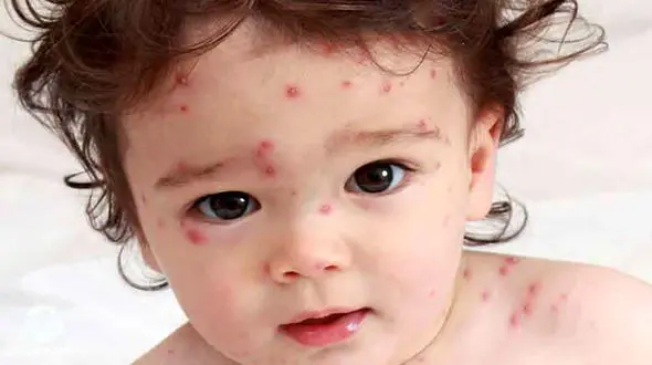 سرخک ۲۹ نفر را در بابل روانه بیمارستان کرد