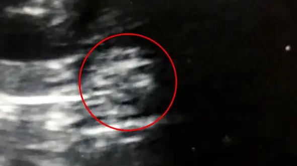 چهره یک روح در تصویر سونوگرافی جنین+ عکس