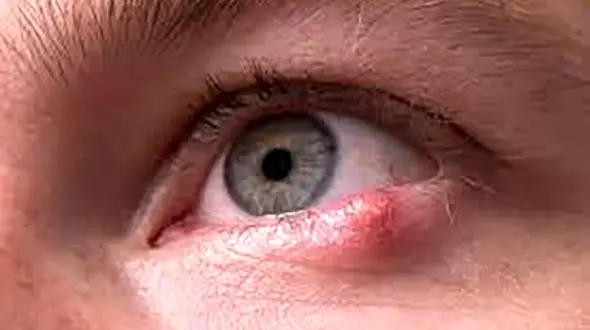 علائم و درمان تبخال چشم چیست؟