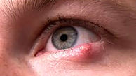 علائم و درمان تبخال چشم چیست؟